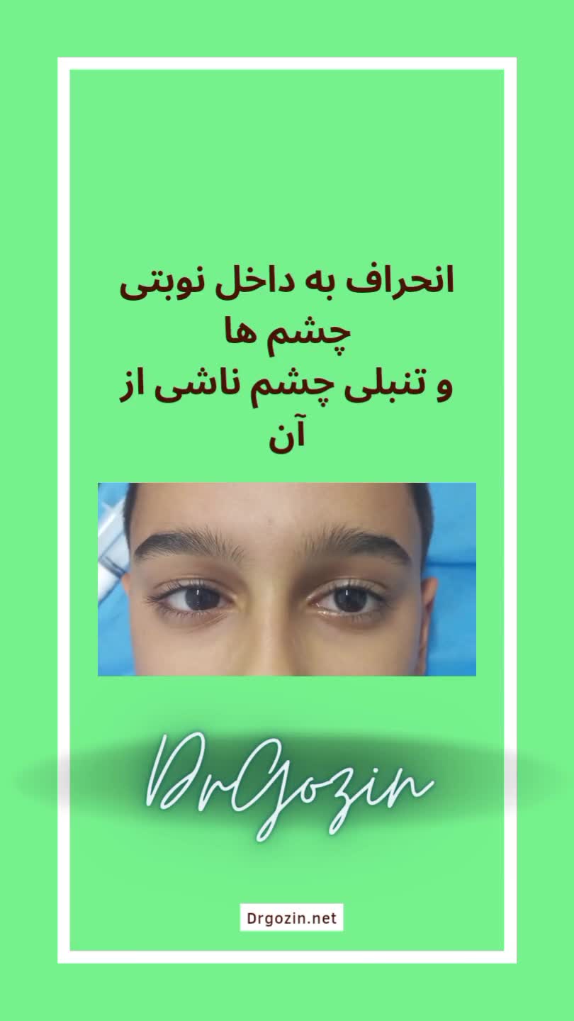 بهترین فوق تخصص انحراف چشم کودکان دکتر گزین، جراحی انحراف چشم ارنیزوماب