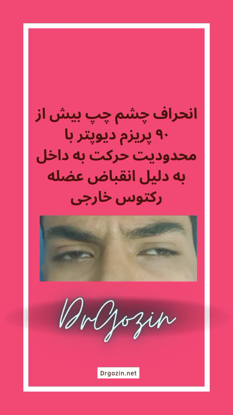 جراحی انحراف چشم دکتر گزین، بهتری فوق تخصص استرابیسم پوشش زخم هیدروکلوییدی