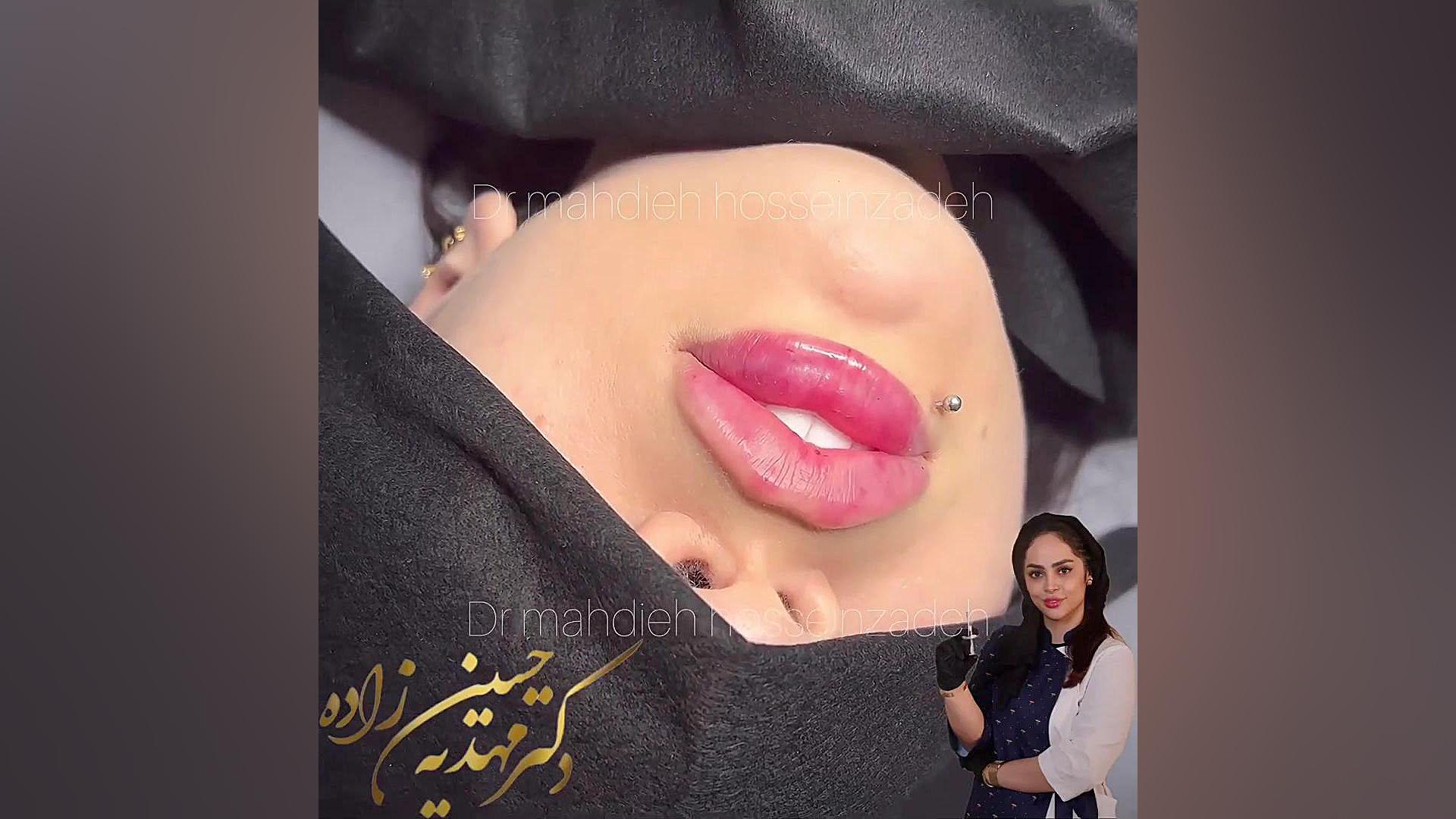 بهترین کلینیک زیبایی در رشت دکتر مهدیه حسین زاده تزریق لب روسی کلینیک زیبایی رشت دکتر مهدیه حسین زاده