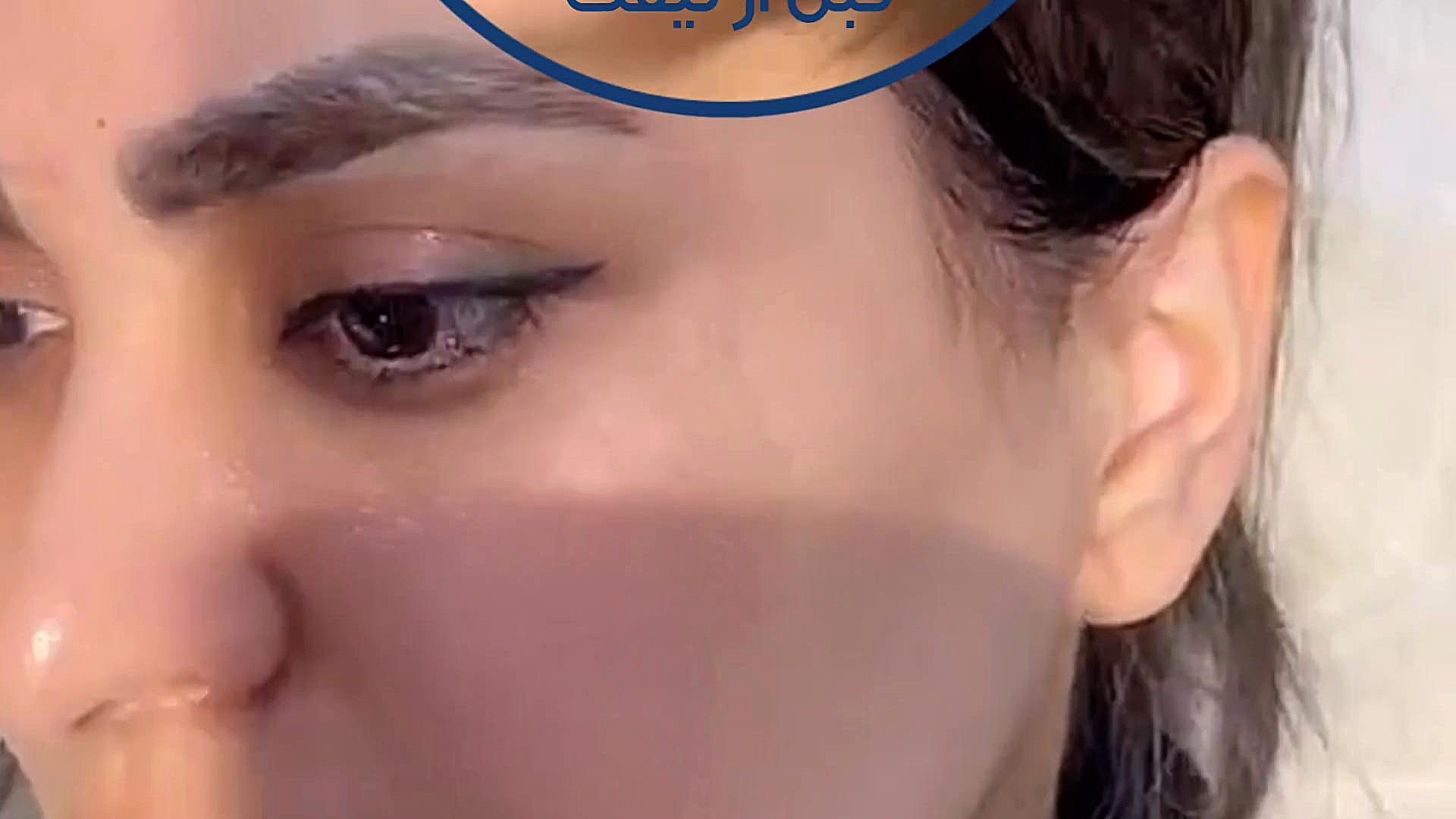 لیفت صورت با نخ پرمترکسد