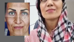 اصلاح فرم بینی - دکتر لیلا شریفی