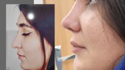قبل و بعد عمل زیبایی بینی - رفع افتادگی نوک بینی