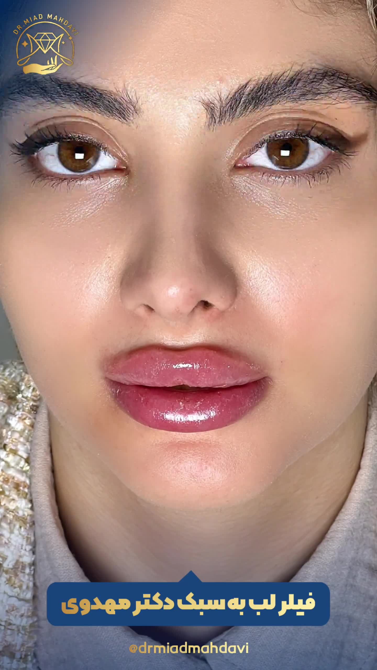 ژل لب روسی اسلامشهر | دکتر میعاد مهدوی | کلینیک پوست و مو زیبایی اسلامشهر آکاتیزیا