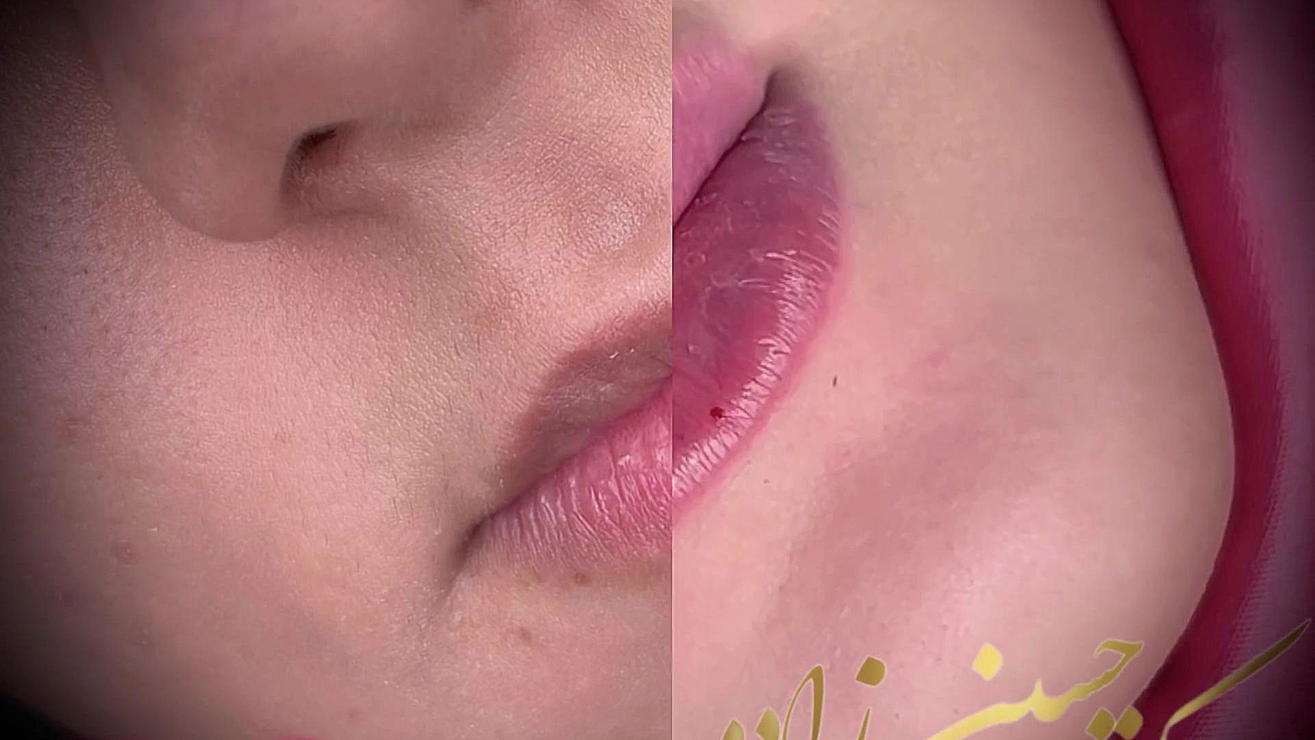 تزریق لب روسی در رشت بهترین کلینیک زیبایی در رشت دکتر مهدیه حسین زاده کلینیک زیبایی رشت دکتر مهدیه حسین زاده