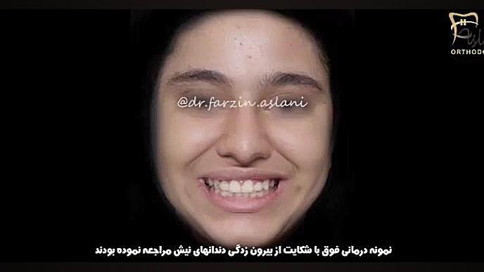 استفاده از ارتودنسی برای دندان های بیرون زده نیش بررسی لک صورت