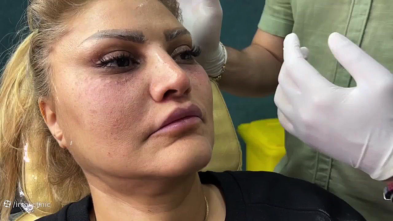 کاربرد تزریق ژل و تزریق بوتاکس به چانه دستگاه آنالیز اگزوزوم