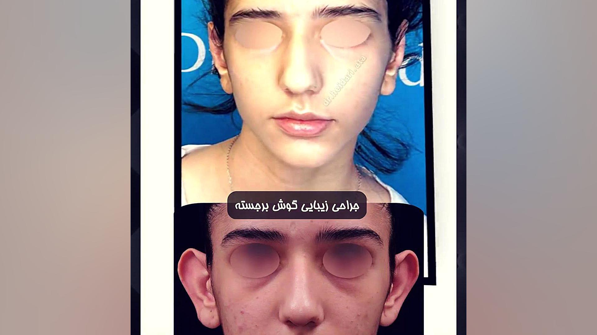 جراحی زیبایی گوش برجسته | دکتر حیدری ایوانبرادین