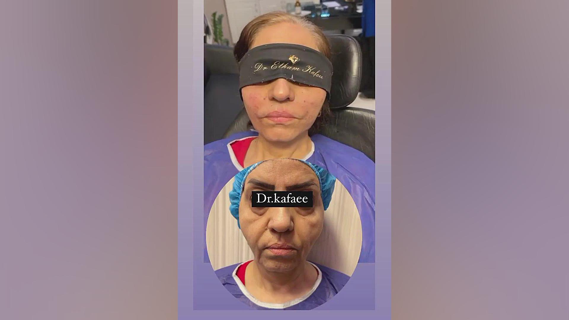 بلافاصله پس از لیفت نخ و تزریق فیلر به صورت روکش دندان