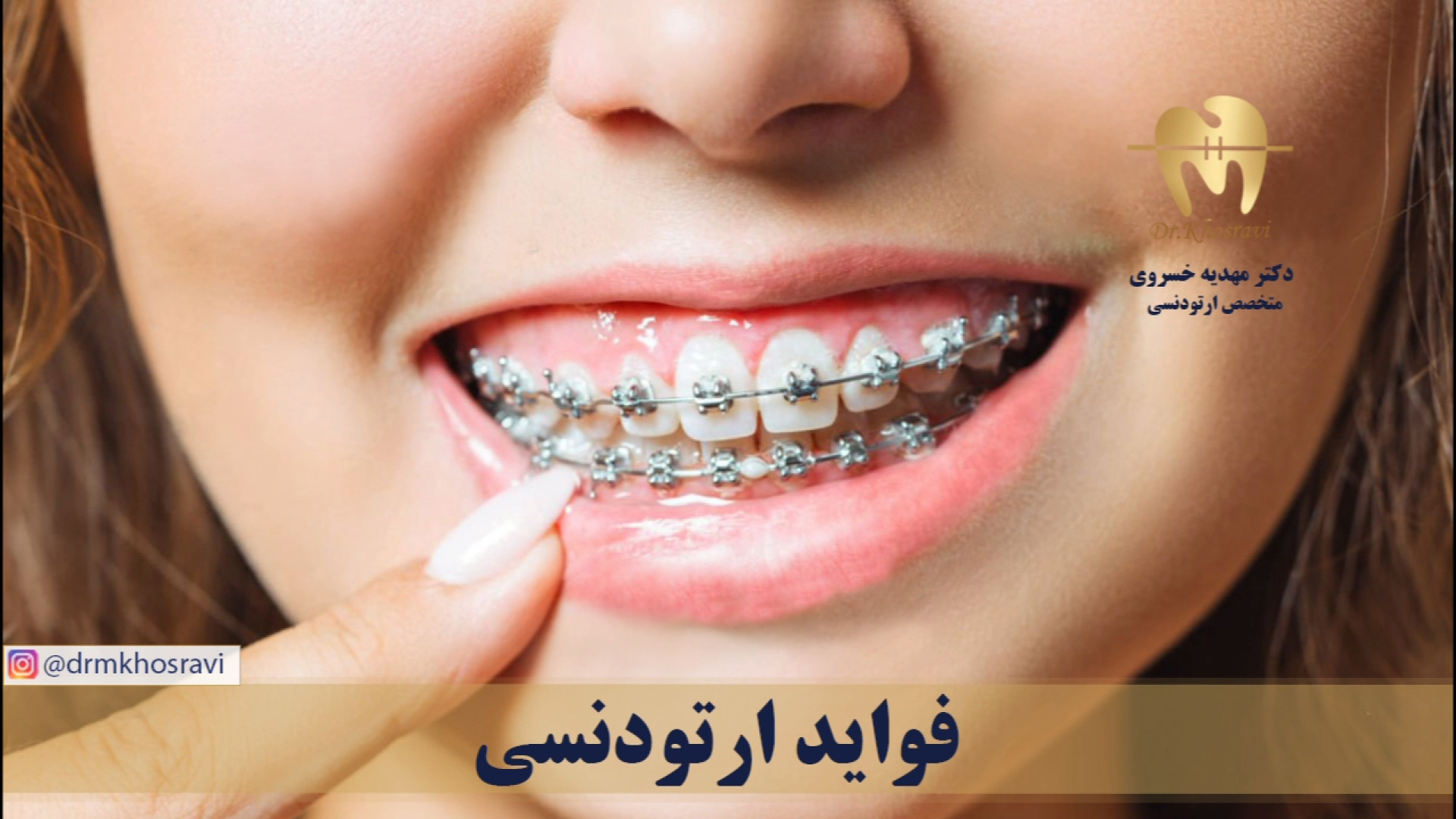 فواید ارتودنسی - دکتر مهدیه خسروی - متخصص ارتودنسی دکتر مهدیه خسروی - متخصص ارتودنسی