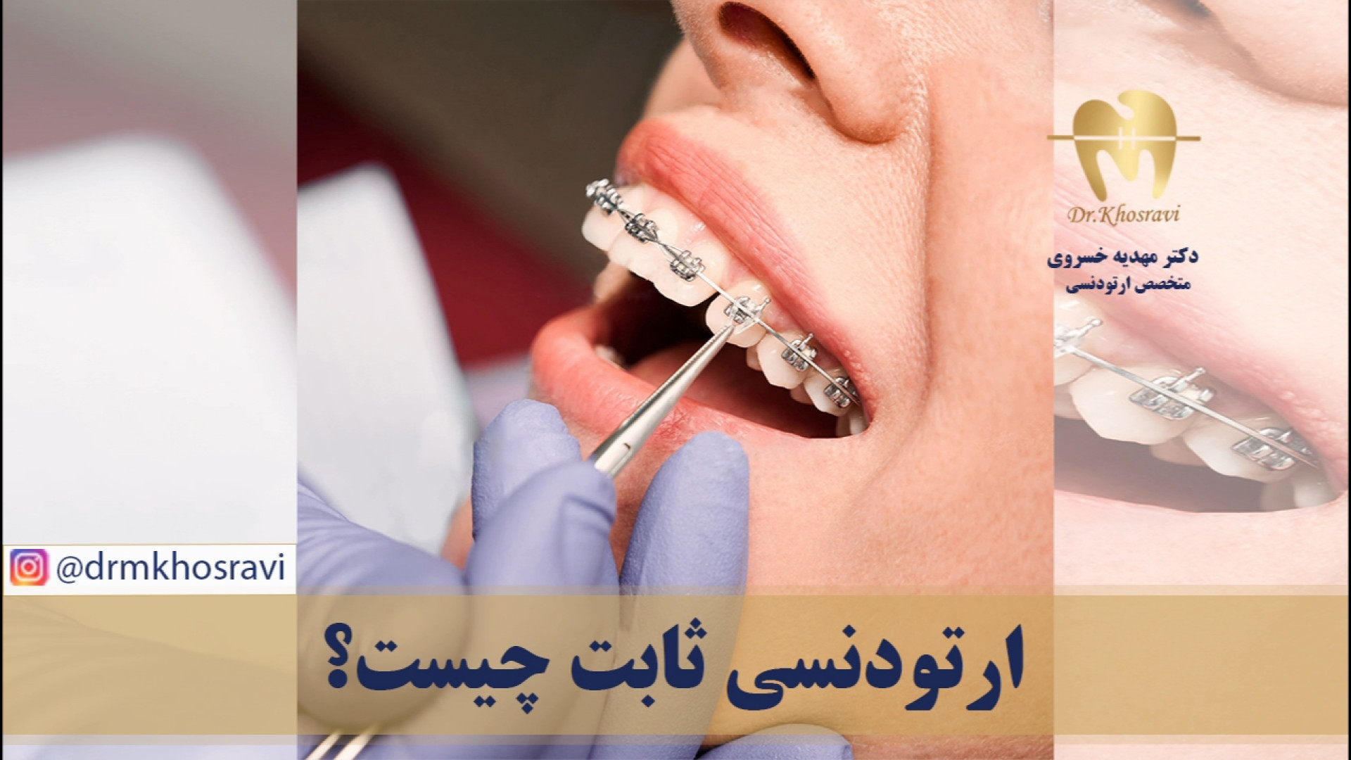 ارتودنسی ثابت چیست؟ - دکتر مهدیه خسروی - متخصص ارتودنسی دکتر مهدیه خسروی - متخصص ارتودنسی