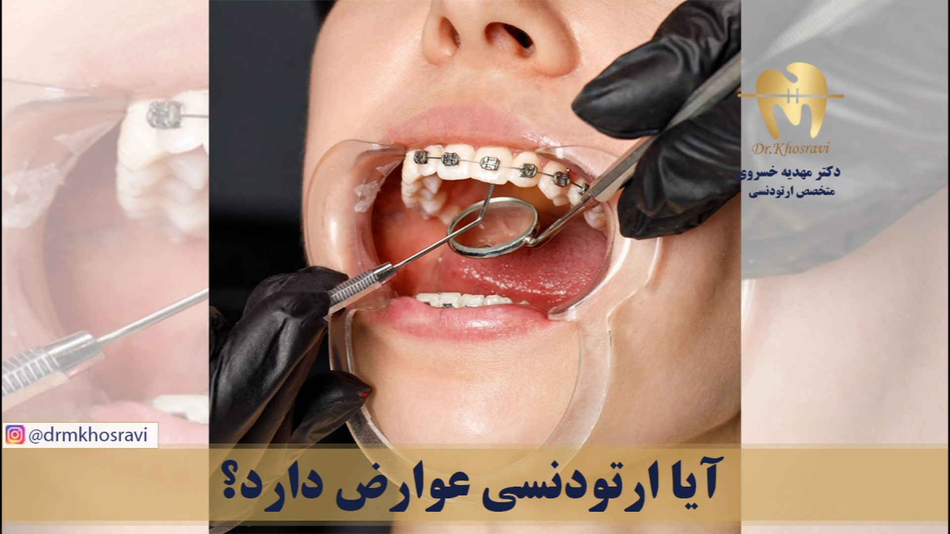 آیا ارتودنسی عوارض دارد؟ - دکتر مهدیه خسروی - متخصص ارتودنسی دکتر مهدیه خسروی - متخصص ارتودنسی