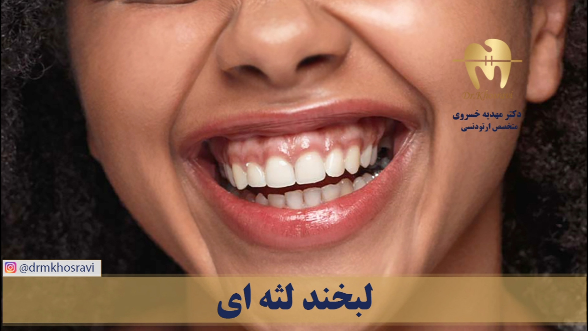 لبخند لثه ای - دکتر مهدیه خسروی - متخصص ارتودنسی لیپوماتیک