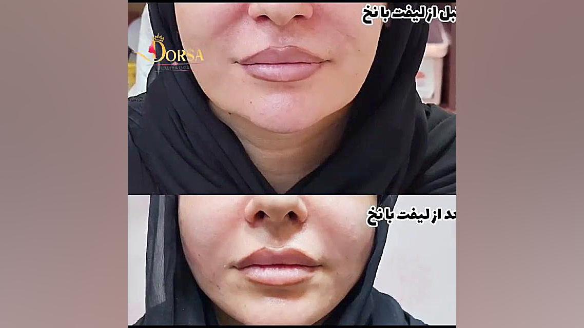 آموزش لیفت صورت با نخ Screening Lentiviral Vector