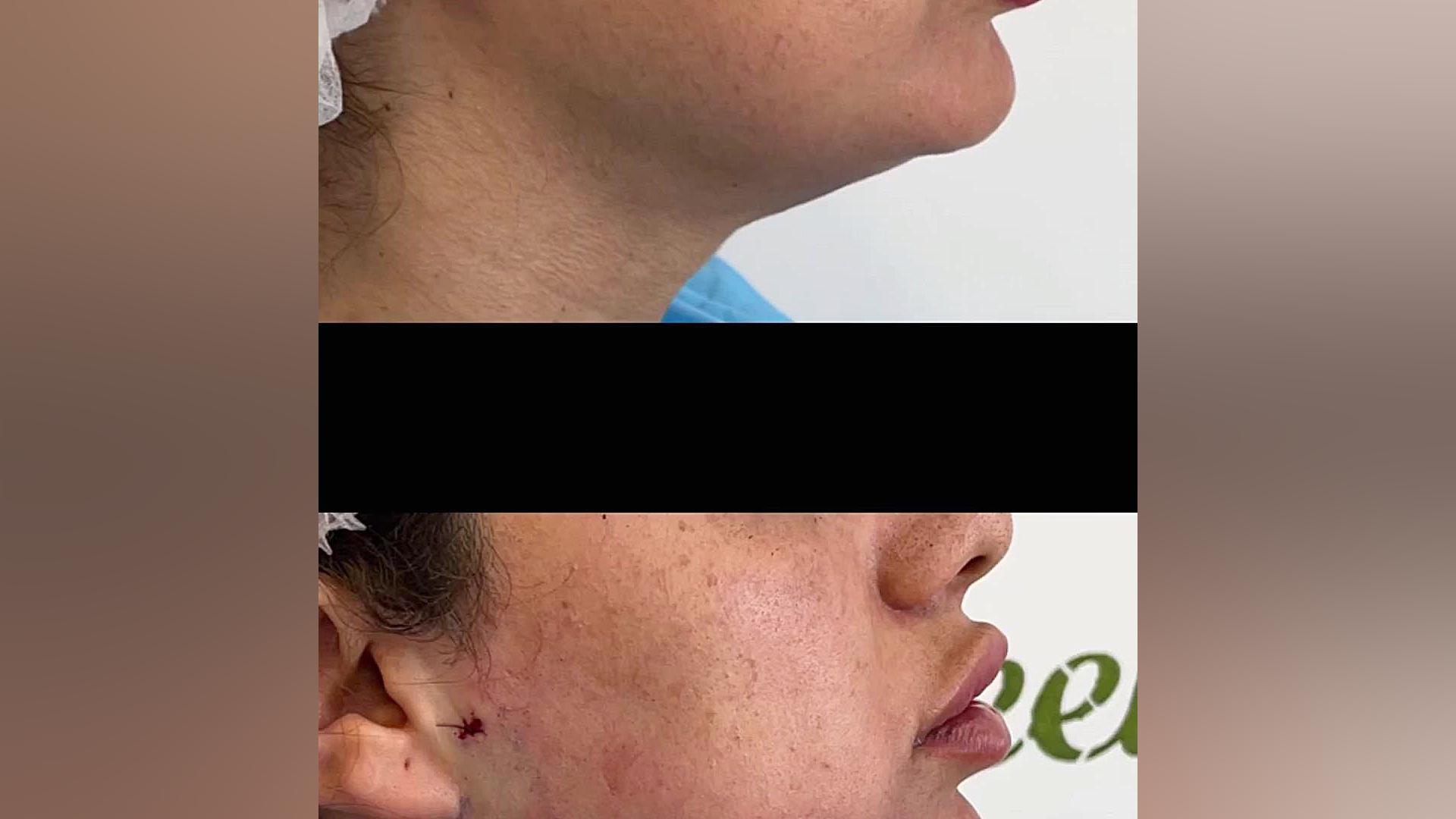 فیلم واقعی لیپوساکشن غبغب Spatial Transcriptomics