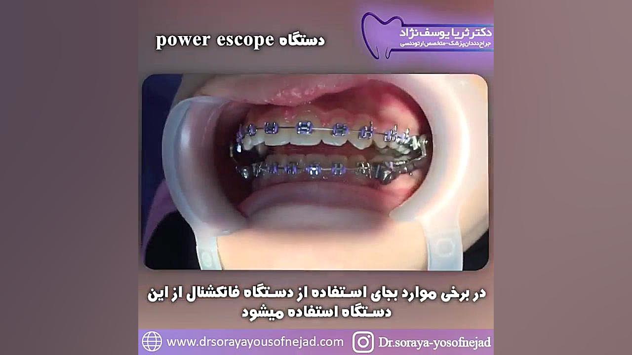 دستگاه power escope دکتر ثریا یوسف نژاد متخصص ارتودنسی بابل