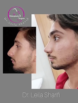 ویدئو قبل و بعد عمل بینی - درمان انحراف بینی - دکتر لیلا شریفی