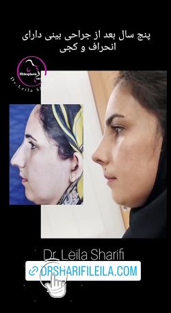 ویدئو قبل و بعد عمل بینی - دکتر لیلا شریفی