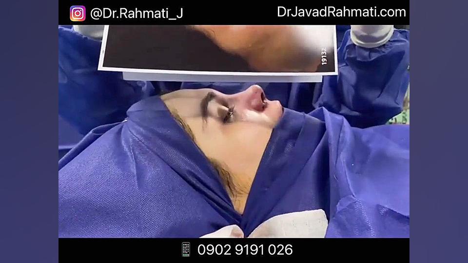 راینوپلاستی چیست دکتر جواد رحمتی