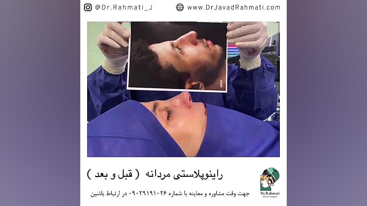 رینوپلاستی برای آقایان دکتر جواد رحمتی
