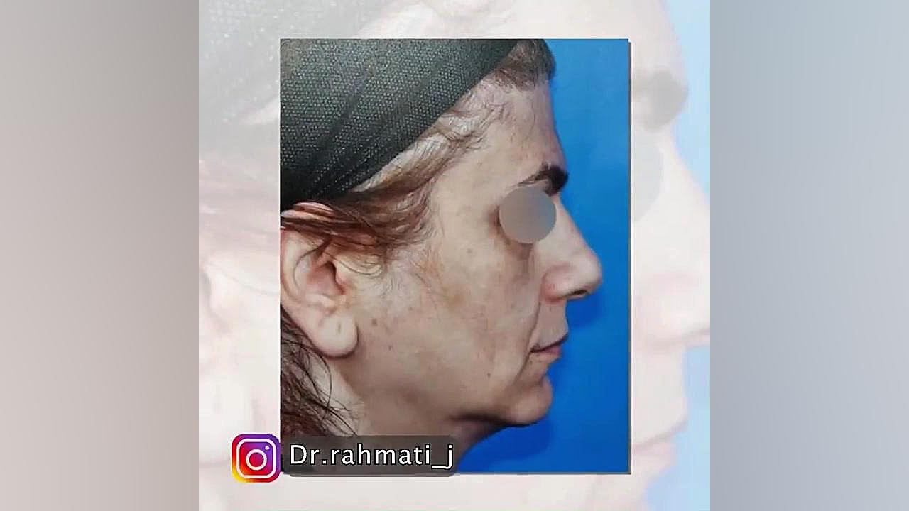 ليفت آندوسكوپيك ابرو دکتر جواد رحمتی