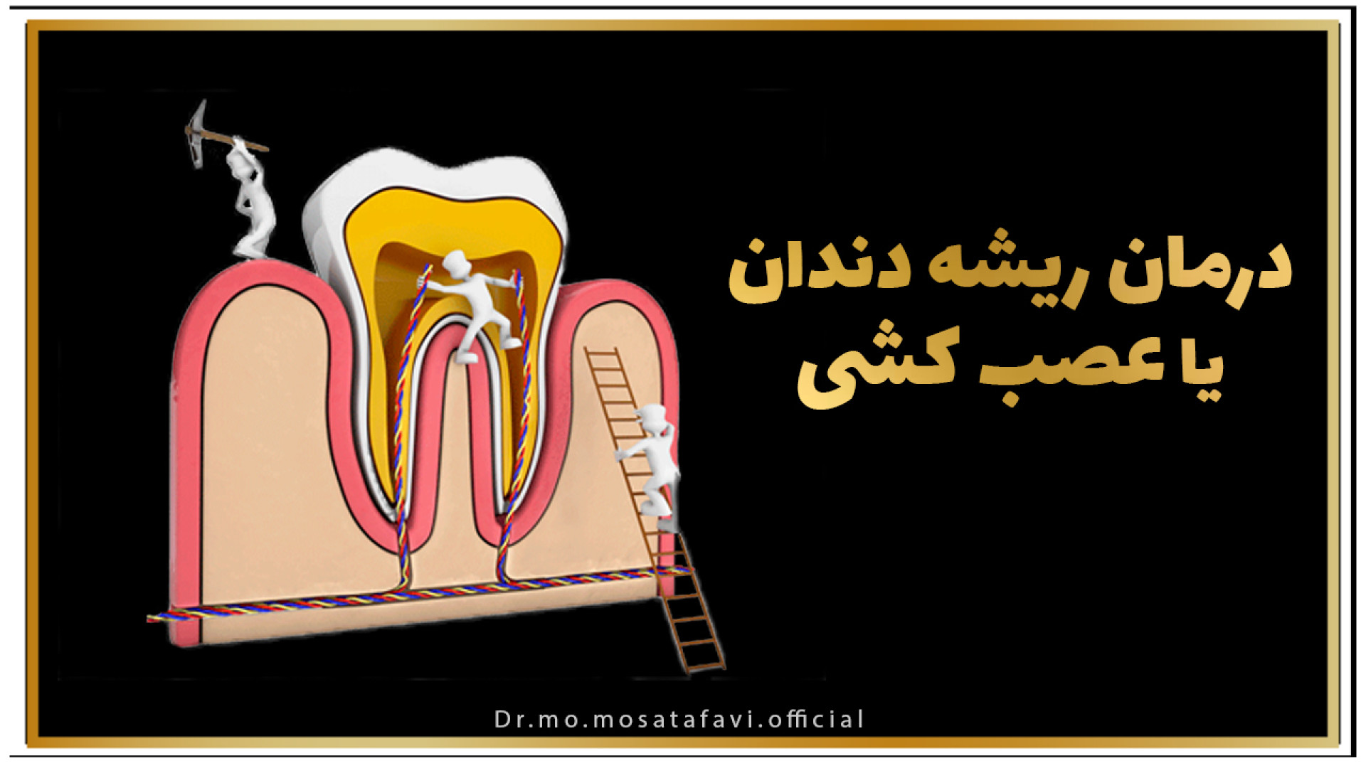 عصب کشی تزریق بوتاکس