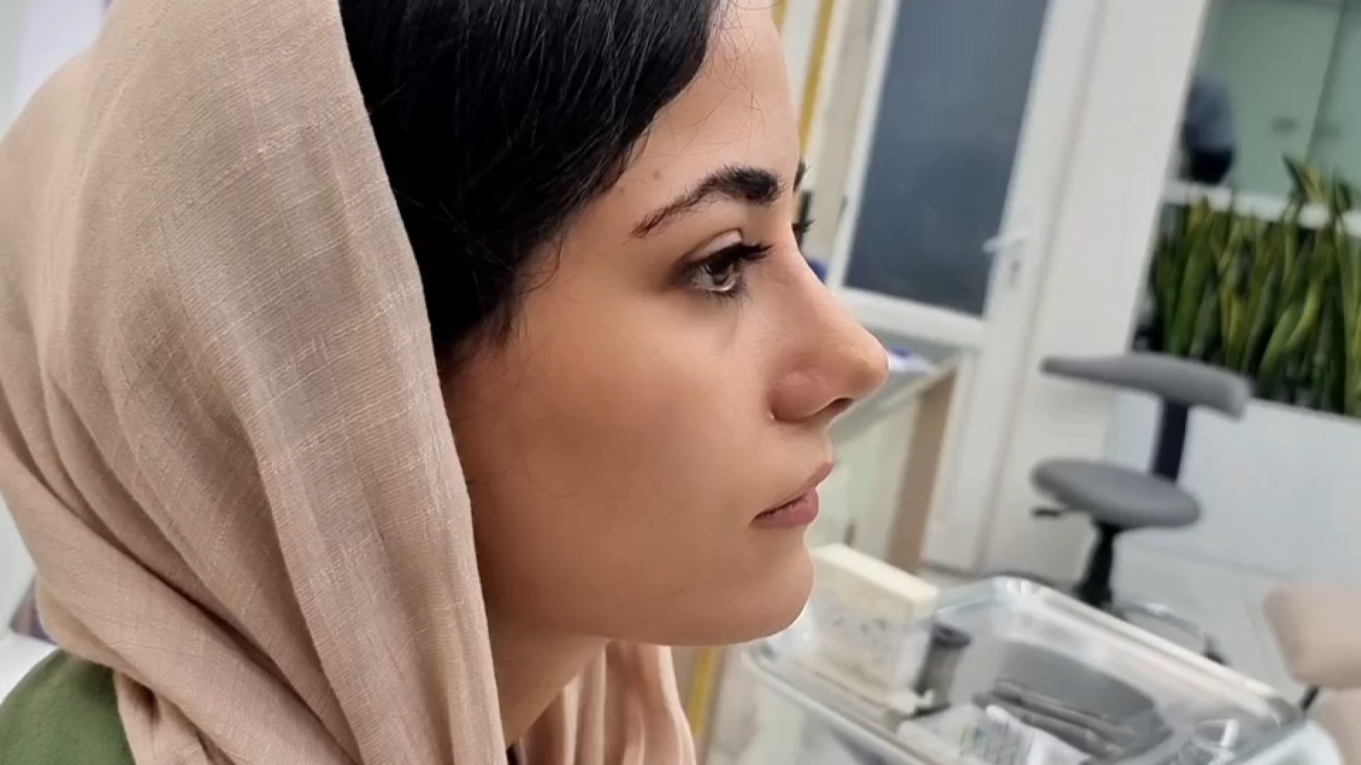 سه هفته بعد از عمل بینی با وجود تورم شدید دکتر علی شفیعی رونیزی | بهترین جراح بینی تهران