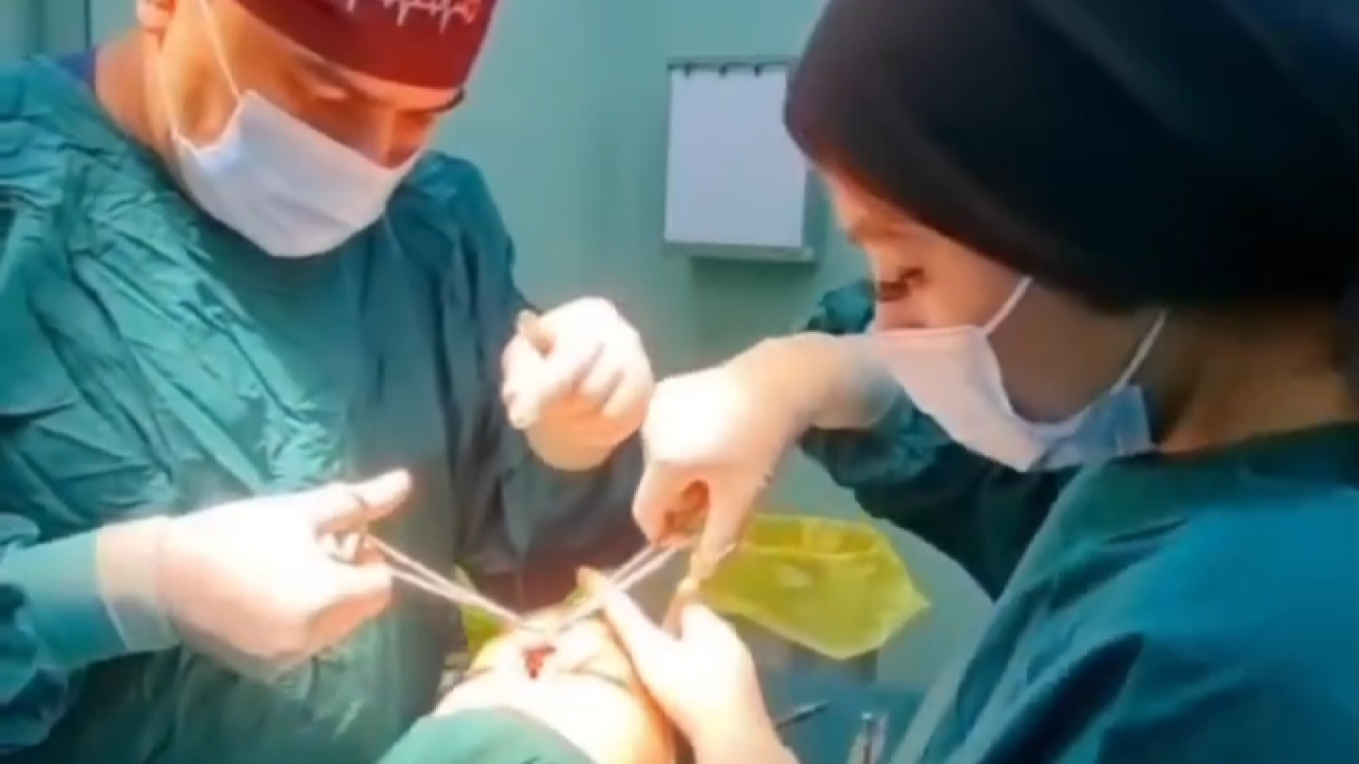 عمل بینی کج دکتر علی شفیعی رونیزی | بهترین جراح بینی تهران