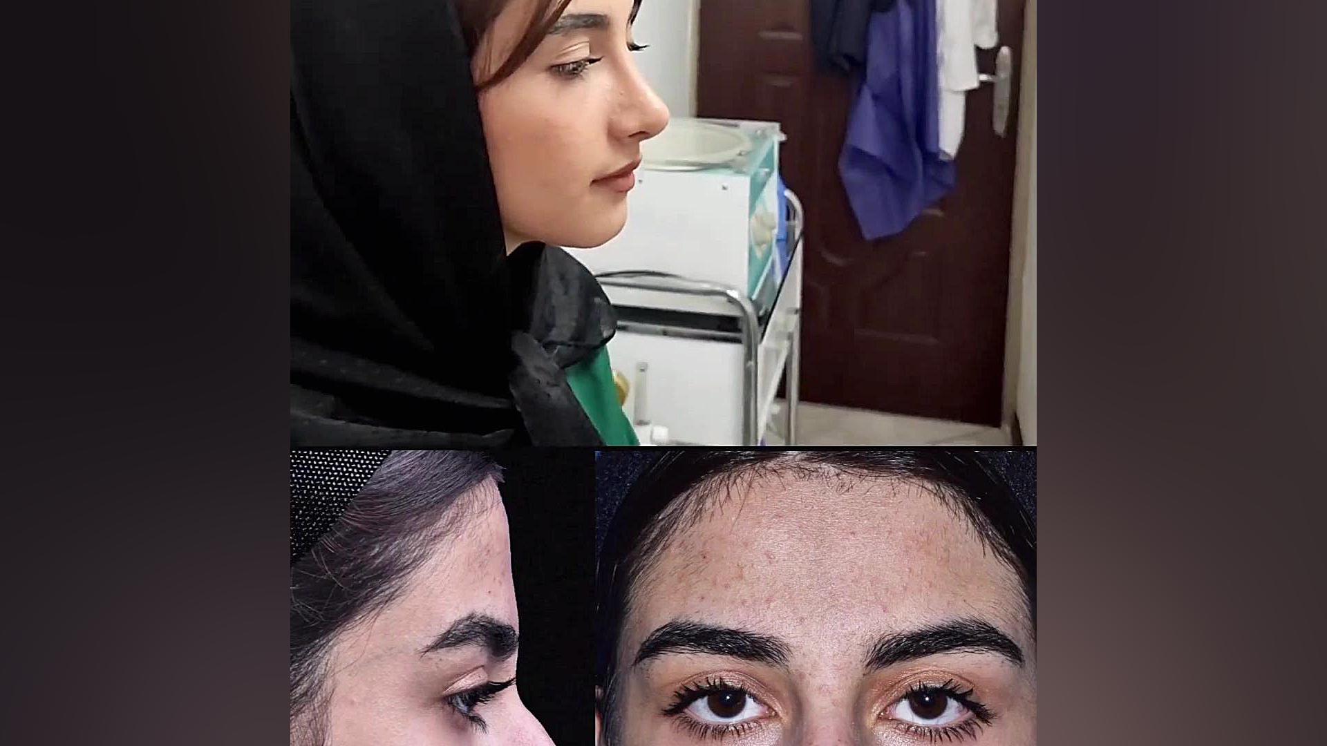 تغییرات عالی در عمل بینی گوشتی دکتر علی شفیعی رونیزی | بهترین جراح بینی تهران
