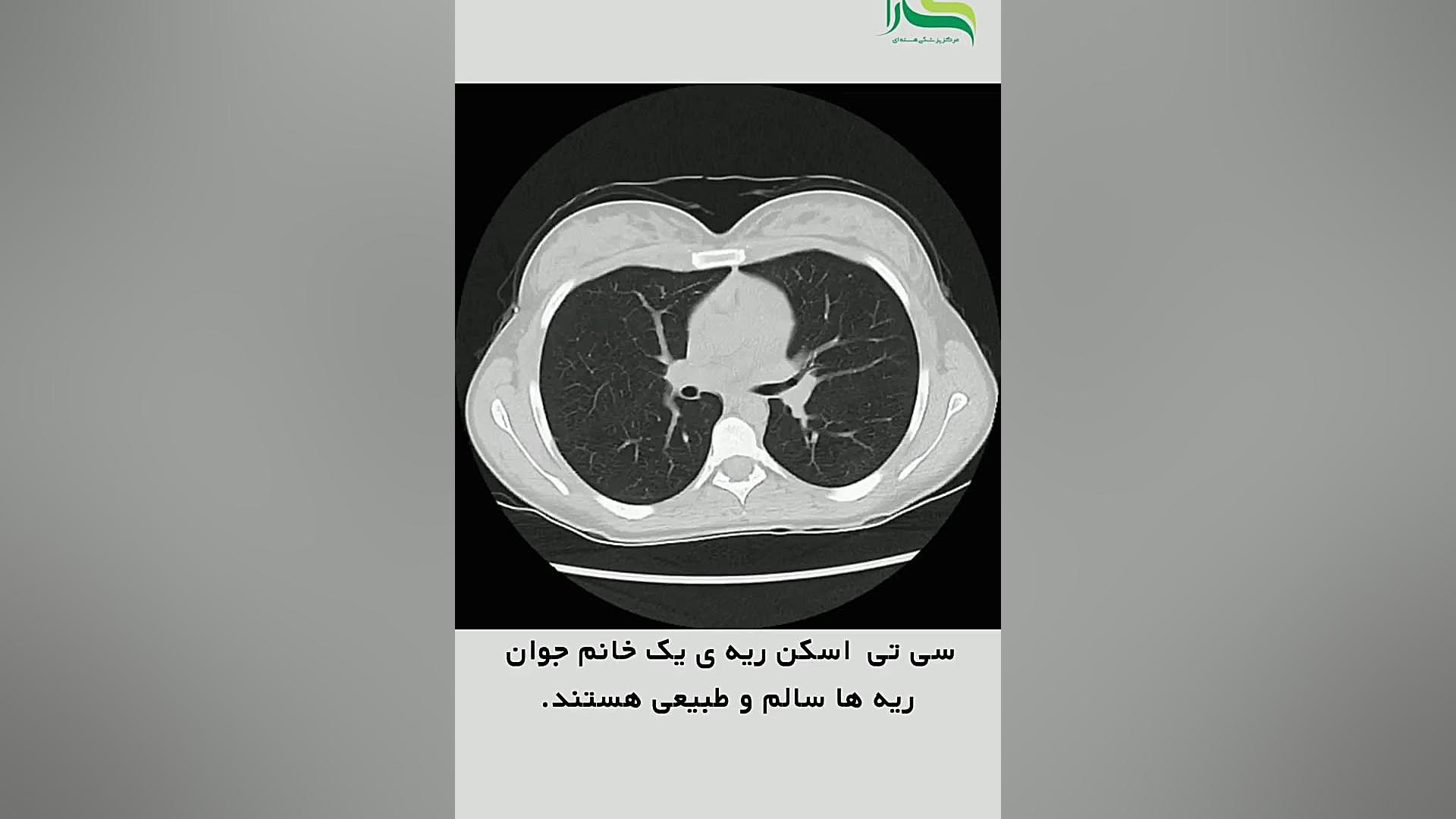 سی تی اسکن ریه یک خانم جوان لیفت پیشانی