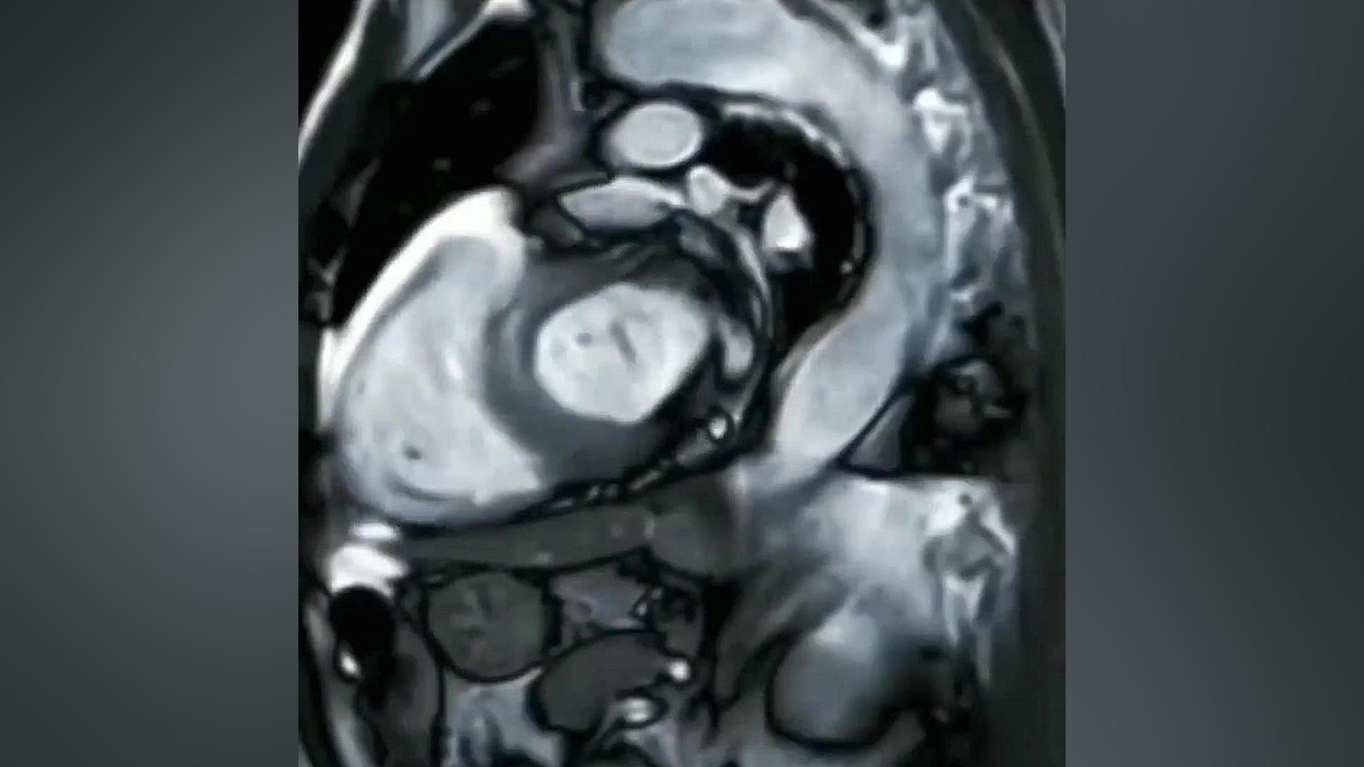 اسکن MRI قلب اما واتسون