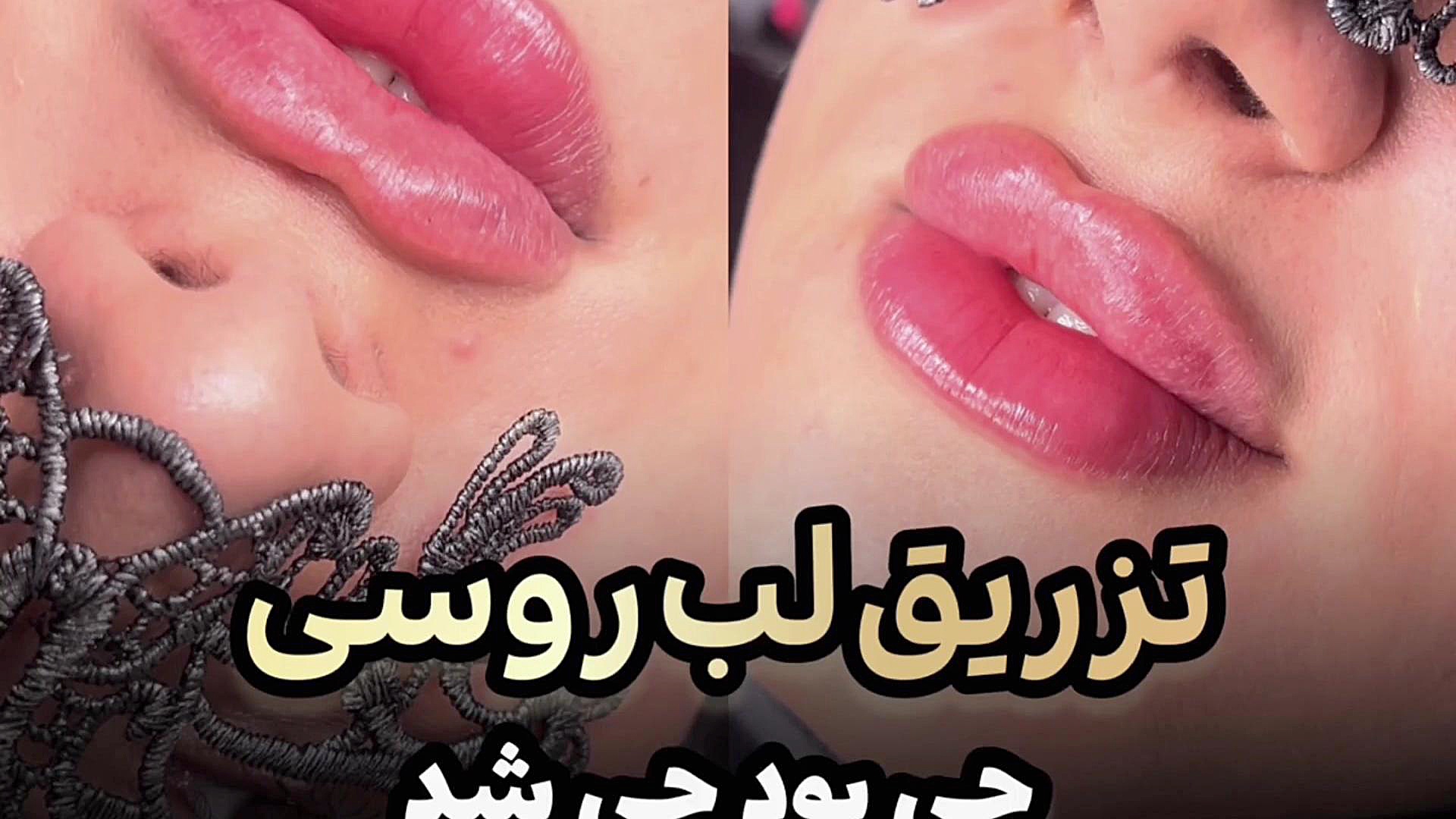 تزریق لب روسی در رشت دکتر مهدیه حسین زاده بهترین کلینیک زیبایی کلینیک زیبایی رشت دکتر مهدیه حسین زاده