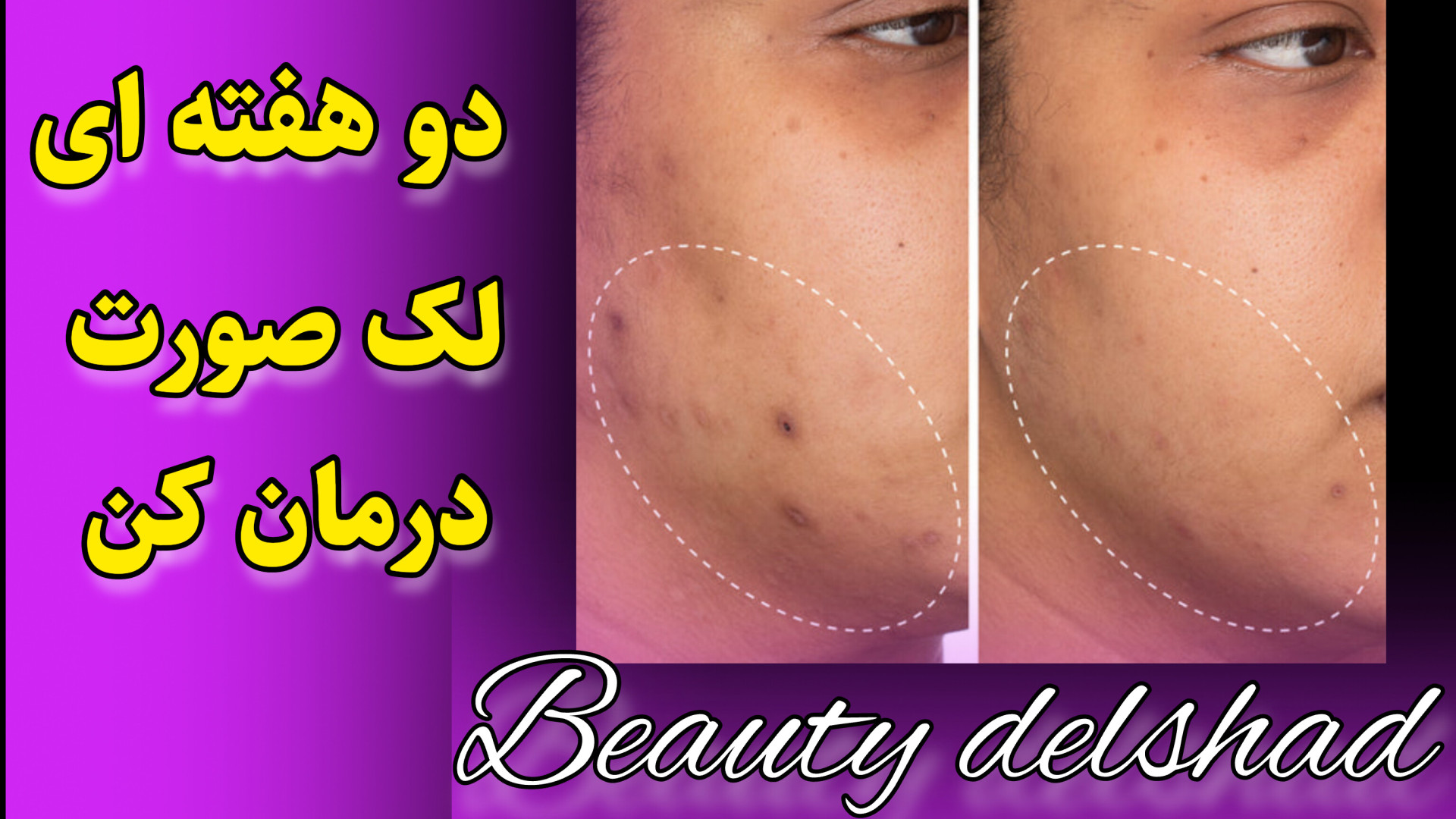 درمان لک صورت درمان لک خونگی رفع چین و چروک