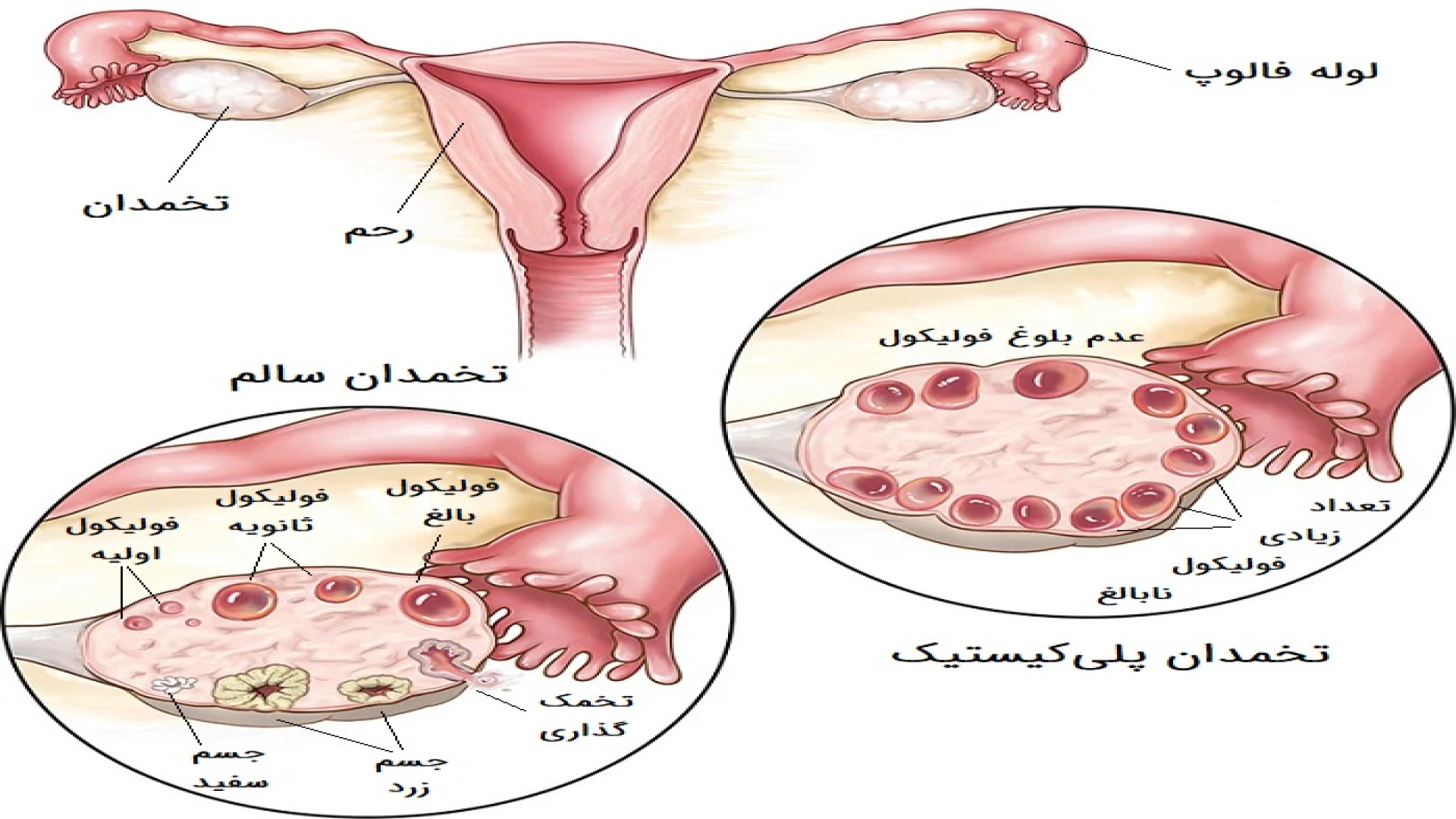 تخمدان پلی کیستیک و عوارض پوستی آن، از پرمویی و آکنه تا ناباروری و ریزش مو جراحی زیبایی پلک