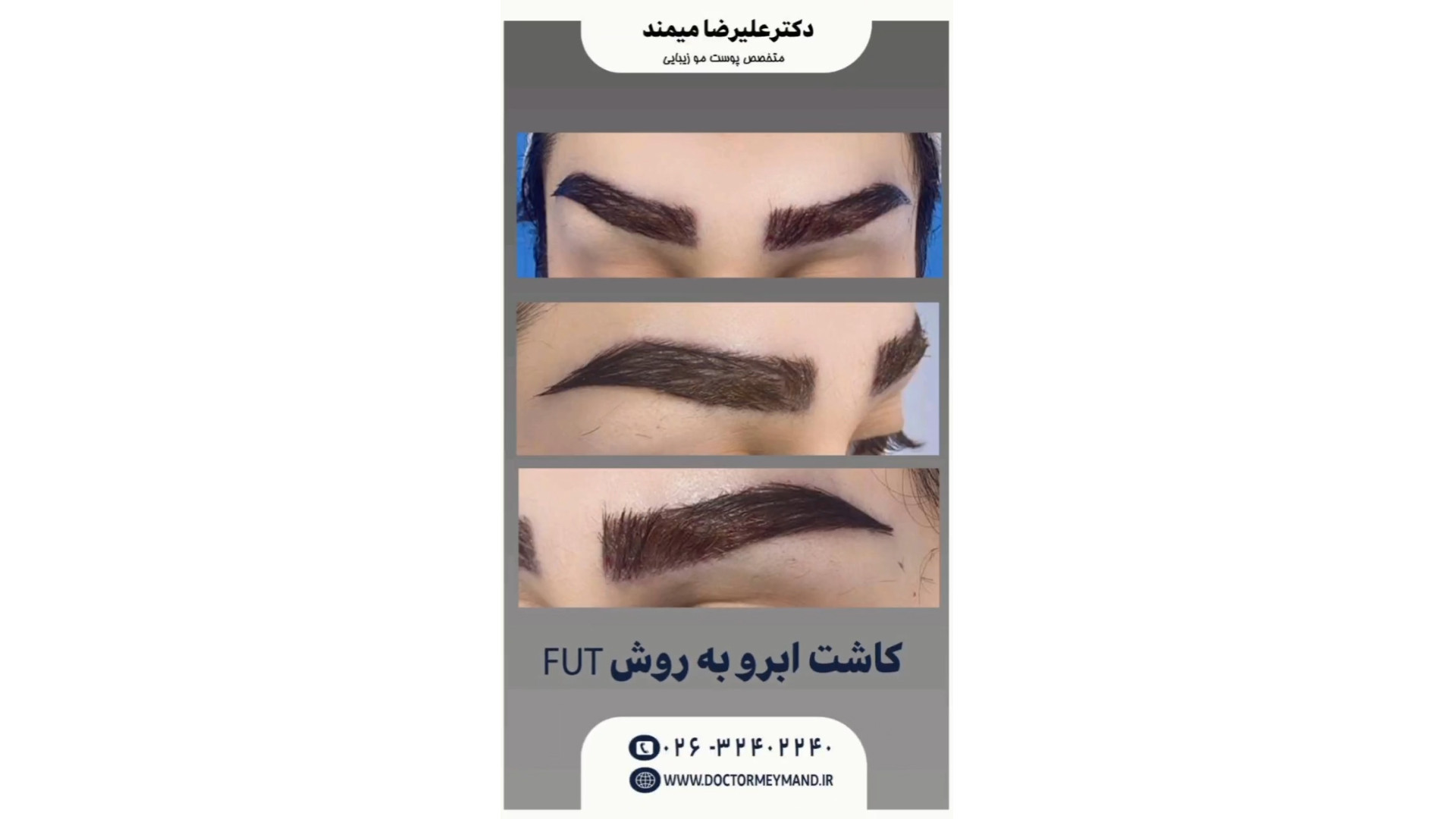 کاشت ابرو به روش fut HiChIP