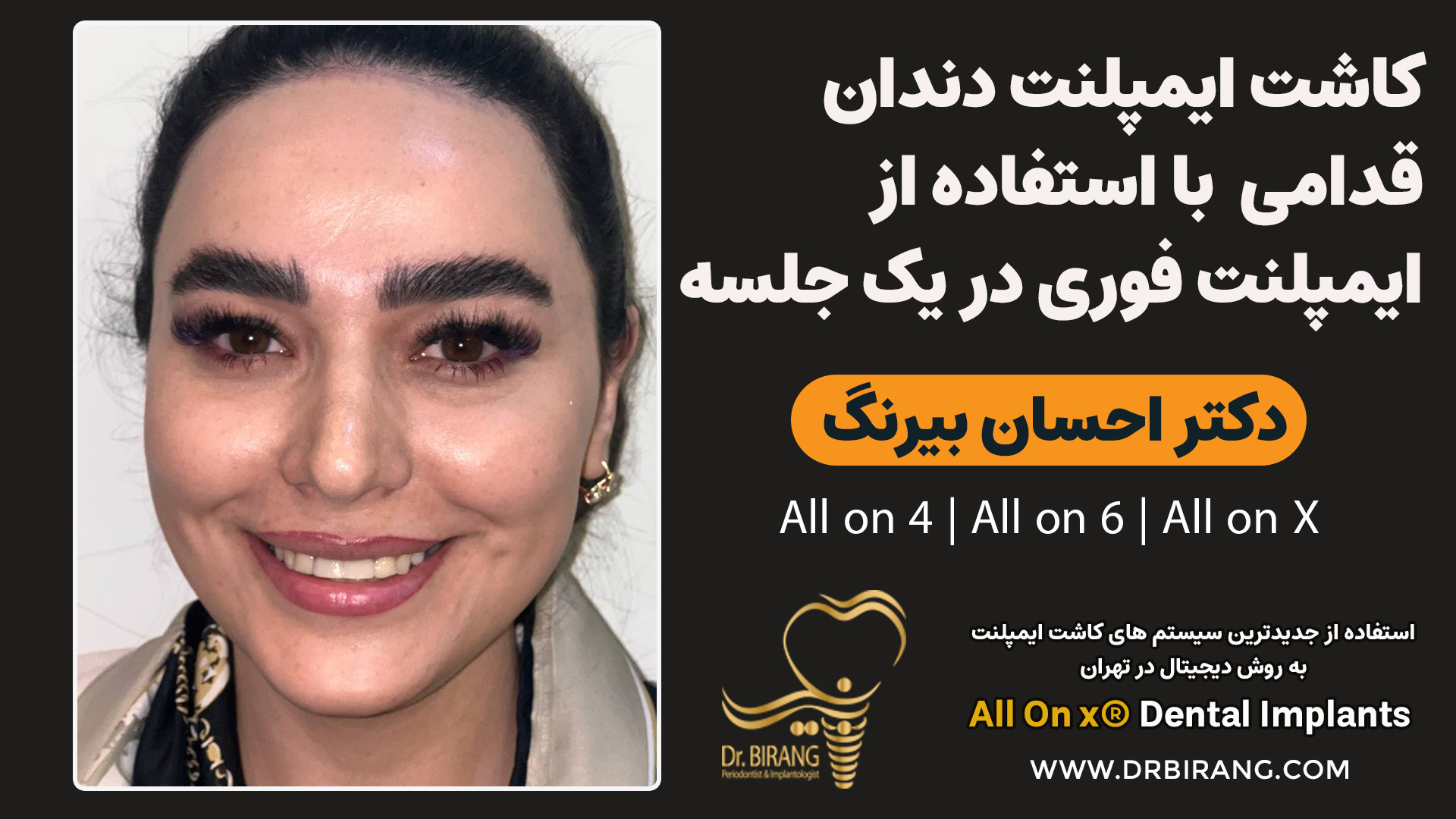 ایمپلنت دندان های جلو(قدامی) با استفاده از ایمپلنت فوری در یک جلسه بیماری بهجت