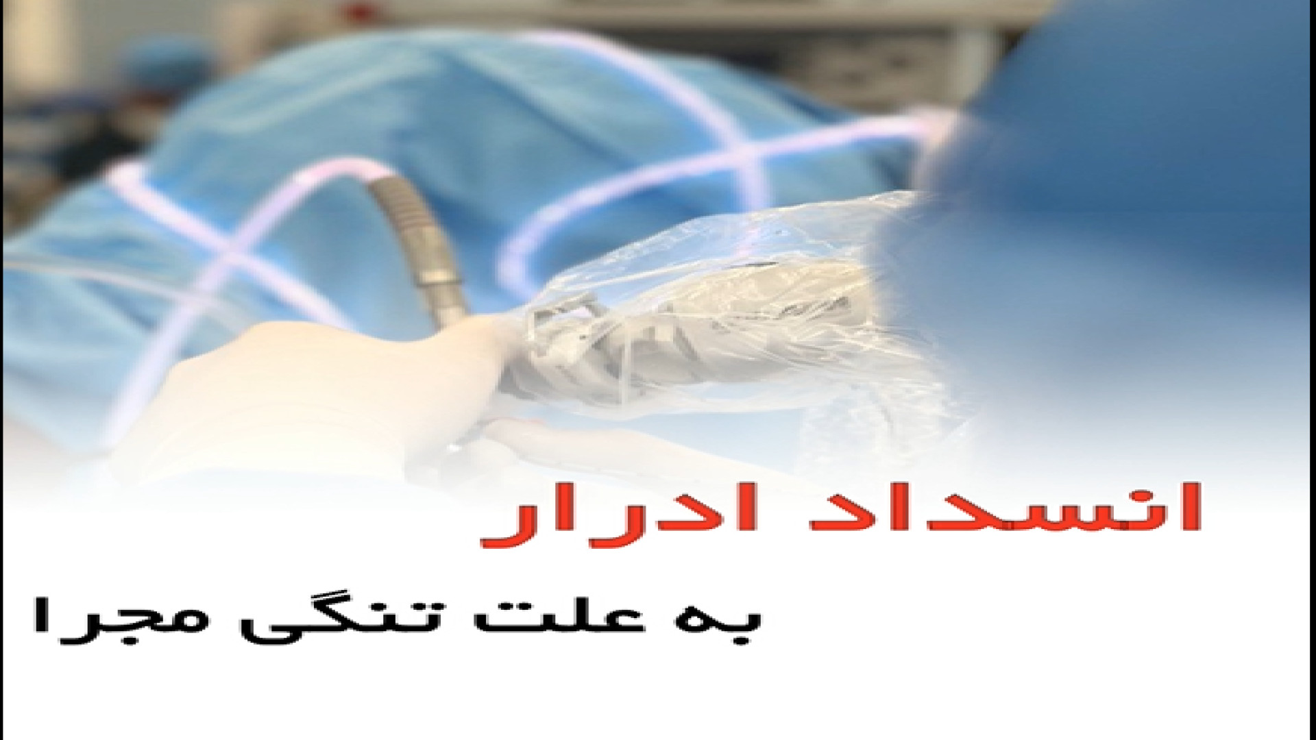 انسداد ادرار به علت تنگی مجرا _ دکتر سید امین میرصادقی کربوکسی تراپی