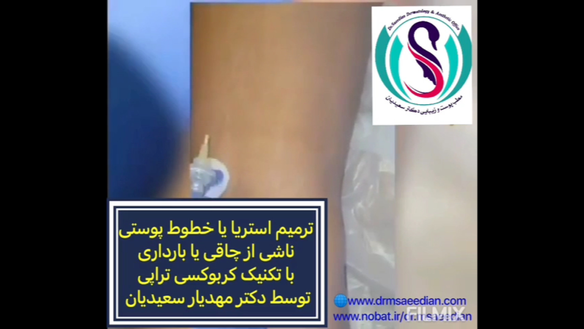 درمان استریا ( Stretch marks) های پوستی با تکنیک کربوکسی تراپی دندان پیش