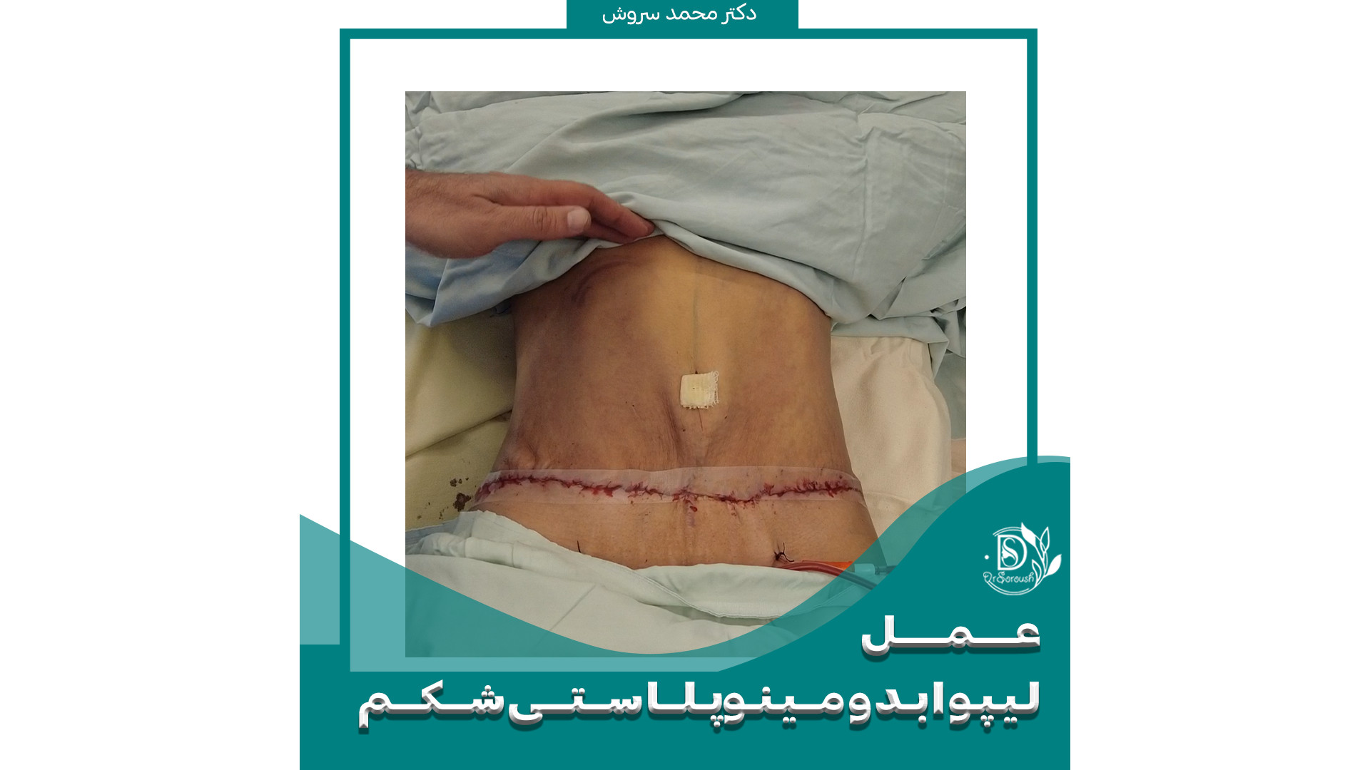 جراحی لیپوابدومینوپلاستی توسط بهترین متخصص دکتر محمد سروش