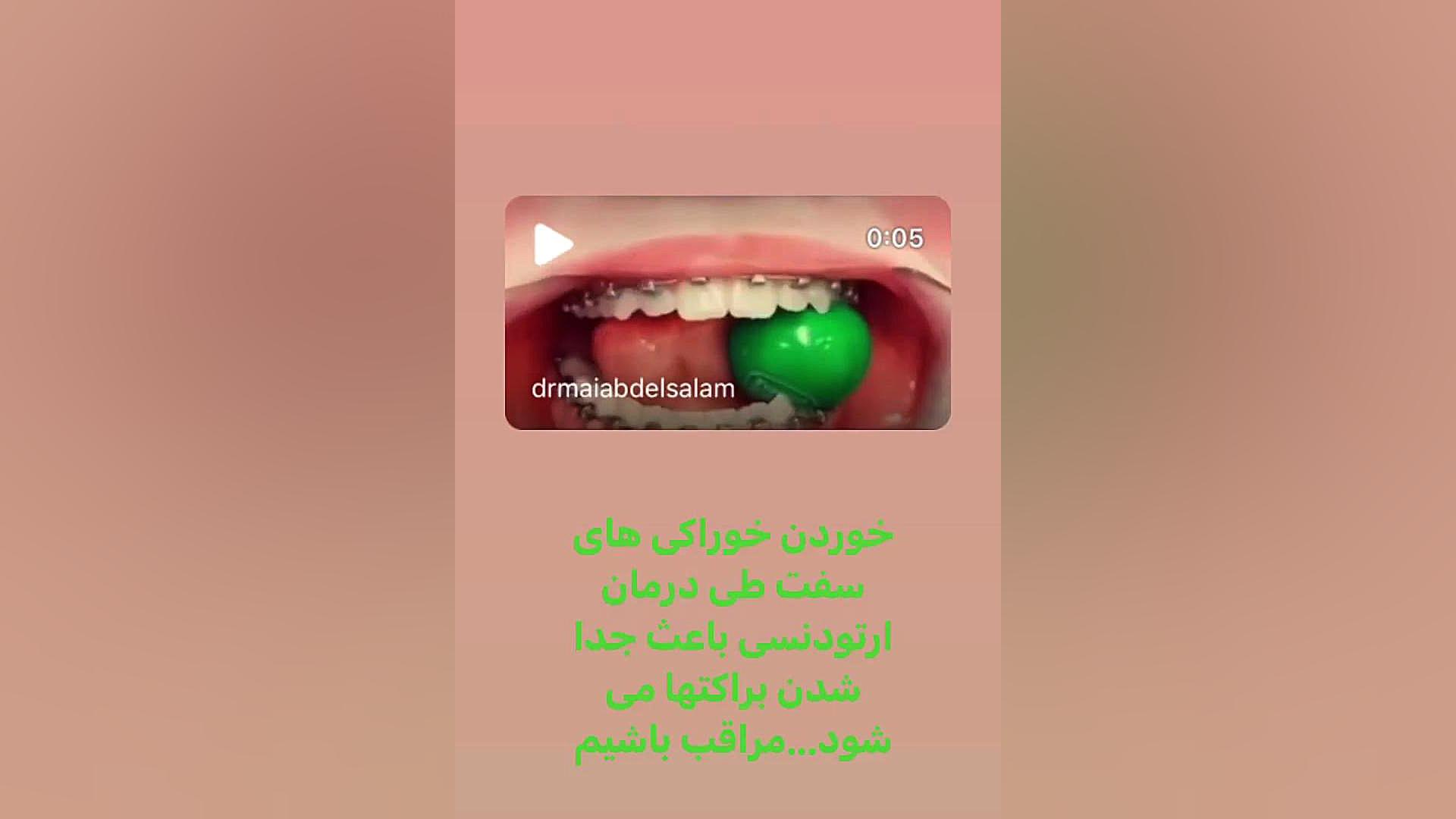 جدا شدن براکتها دكتر مهدي فهيمي هنزائي
