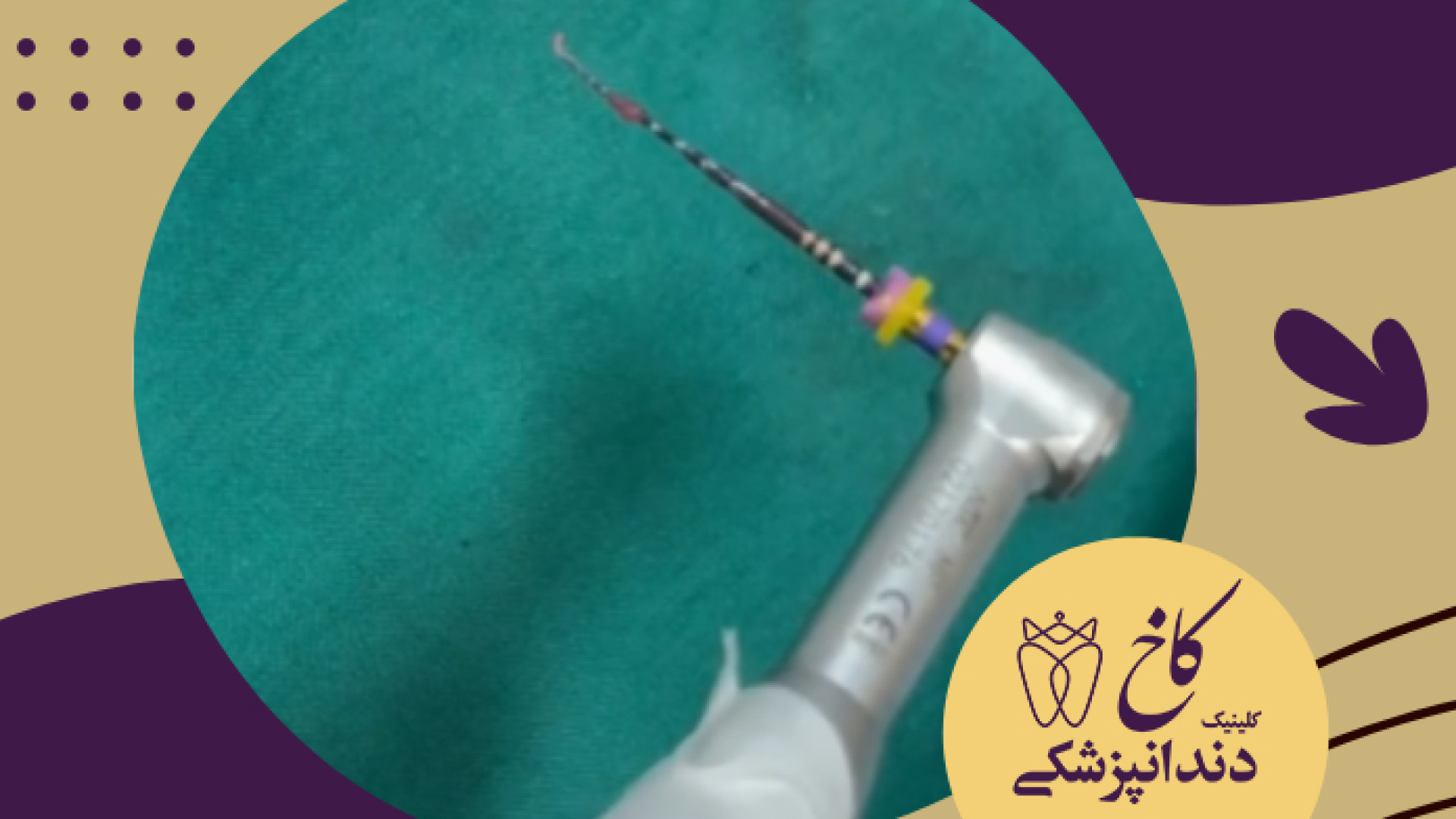 تاحالا عصب دندان از نزدیک دیدید؟ کلینیک دندانپزشکی کاخ