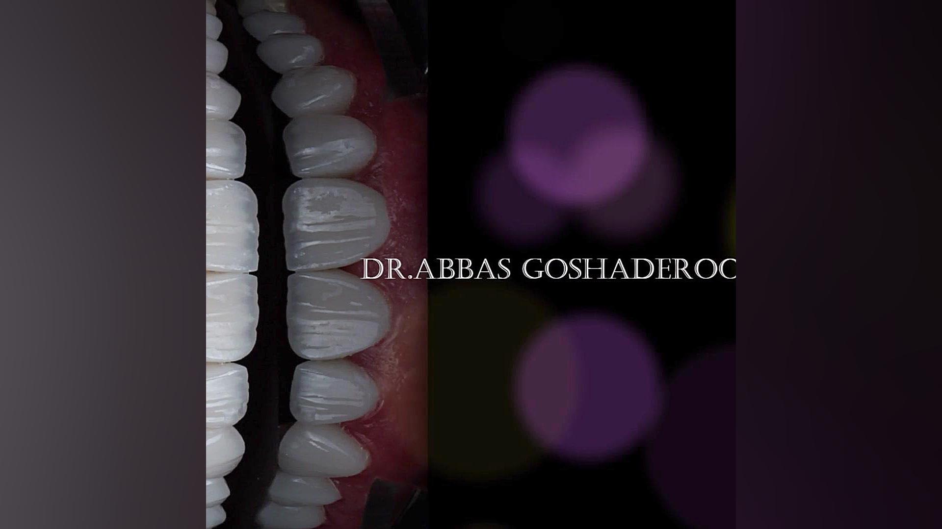 طراحی لبخند با لمینت های سرامیکی دکتر عباس گشاده رو، متخصص جراحی لثه و ایمپلنت