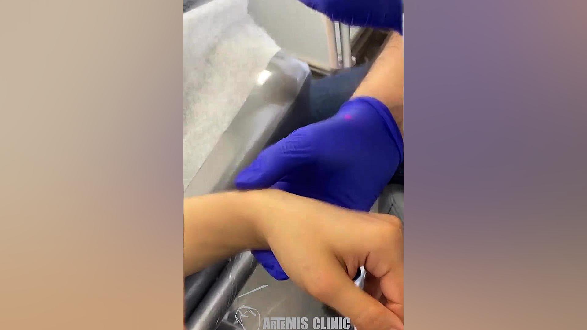رفع پی ای اچ و جای زخم با هلیوس ۳ بلیچینگ