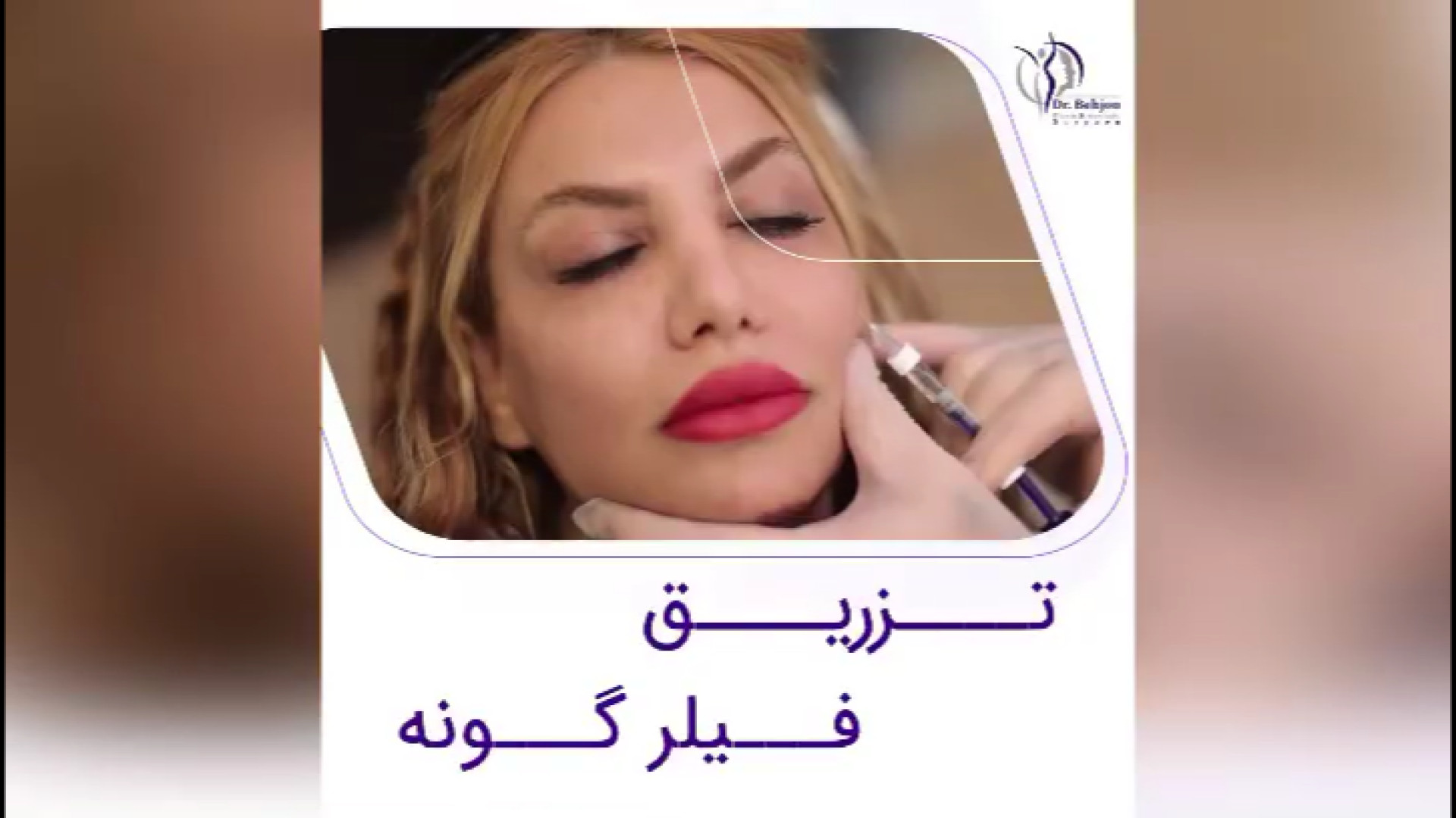 فیلم تزریق فیلر گونه دکتر شاهین بهجو - فوق تخصص جراحی پلاستیک