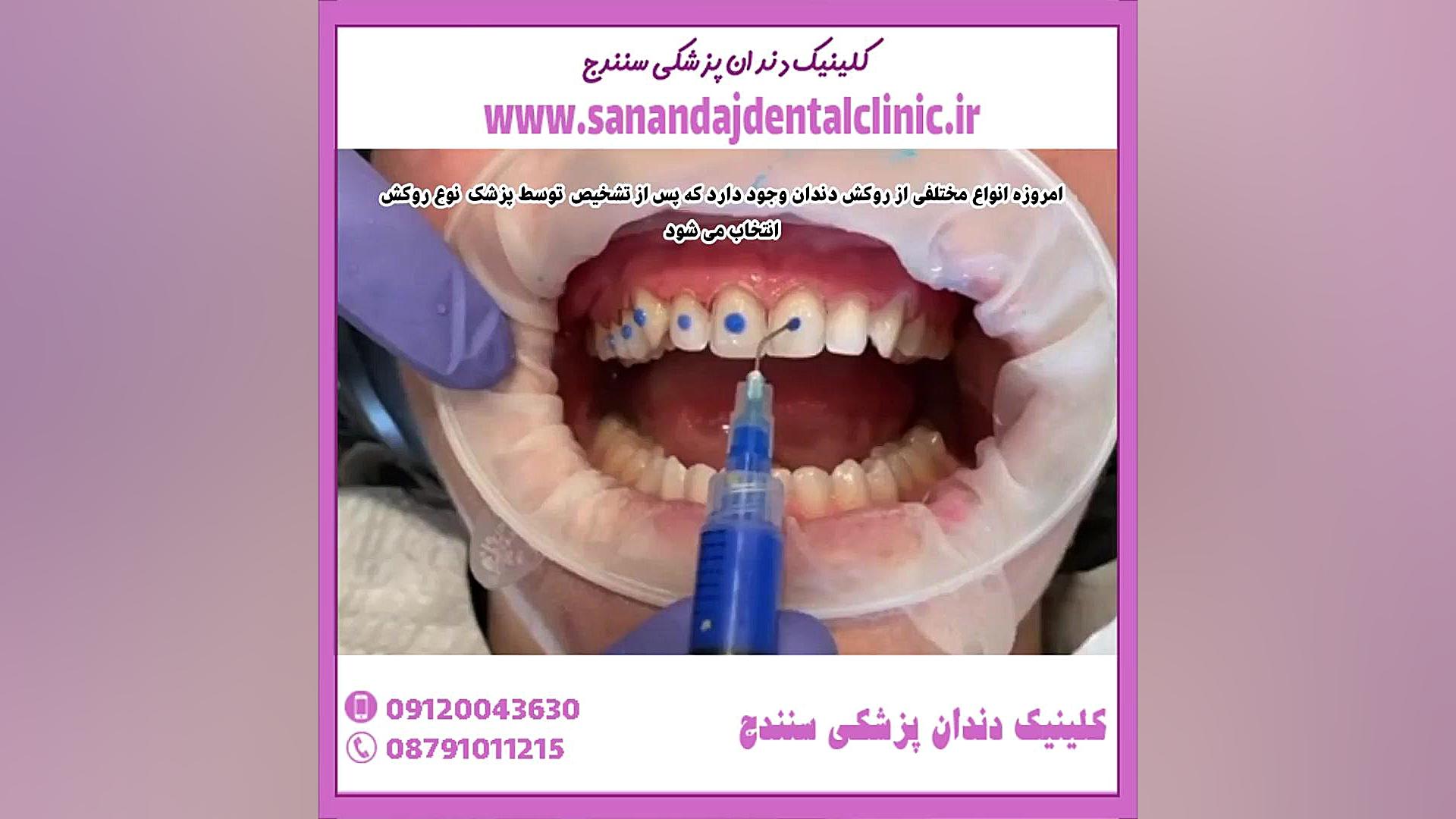روکش دندان مصنوعی تست دفع سدیم ادرار