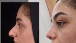 عمل زیبایی بینی زنانه - دکتر لیلا شریفی