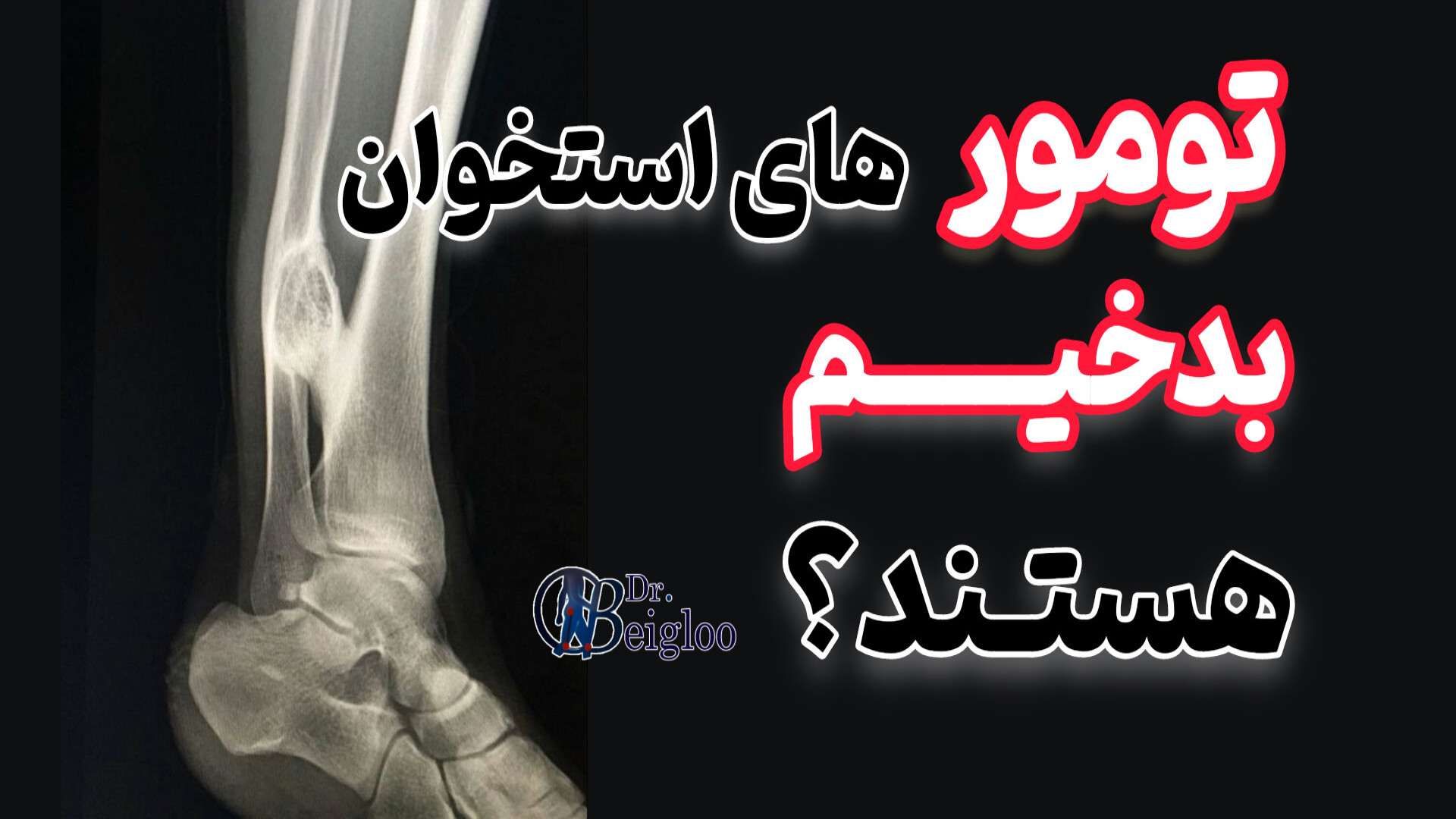 تومور های استخوان بدخیم هستند ؟ دکتر محمود جعفر بیگلو