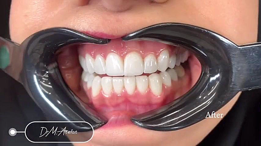 لمینیت سرامیکی در اصفهان | درمان ترکیبی روکش و لمینیت سرامیکی دکتر محمد عاطفت متخصص ترمیمی و زیبایی اصفهان