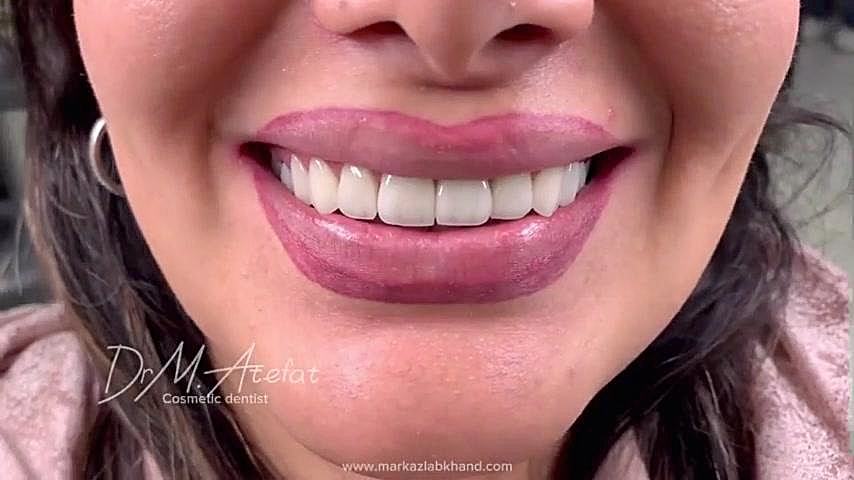 ترکیبی از روکش و لمینیت سرامیکی در اصفهان دکتر محمد عاطفت متخصص ترمیمی و زیبایی اصفهان