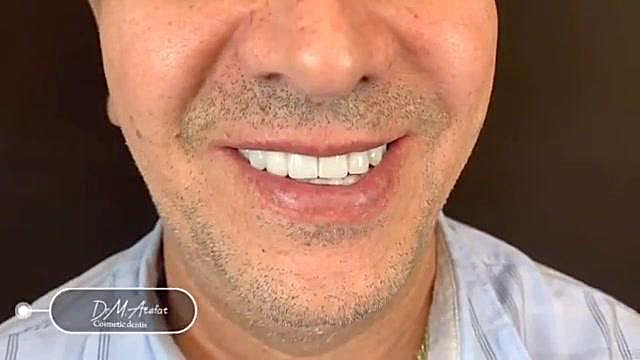 ایمپلنت و روکش سرامیکی دکتر محمد عاطفت متخصص ترمیمی و زیبایی اصفهان