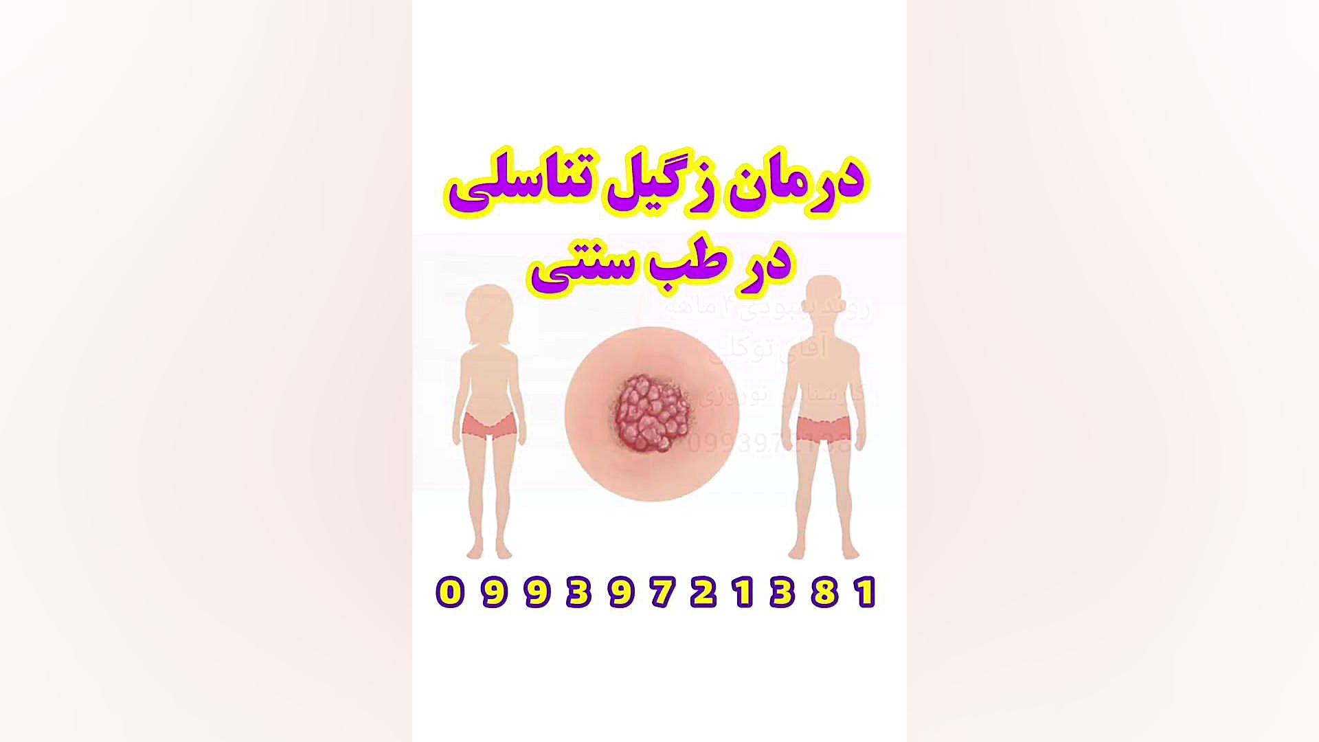زگیل تناسلی در طب‌ سنتی فالو